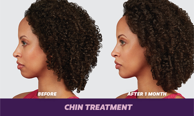 chin treatment 1